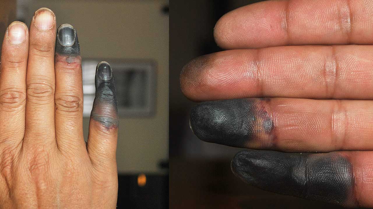 Powell Sharma frostbitten fingers